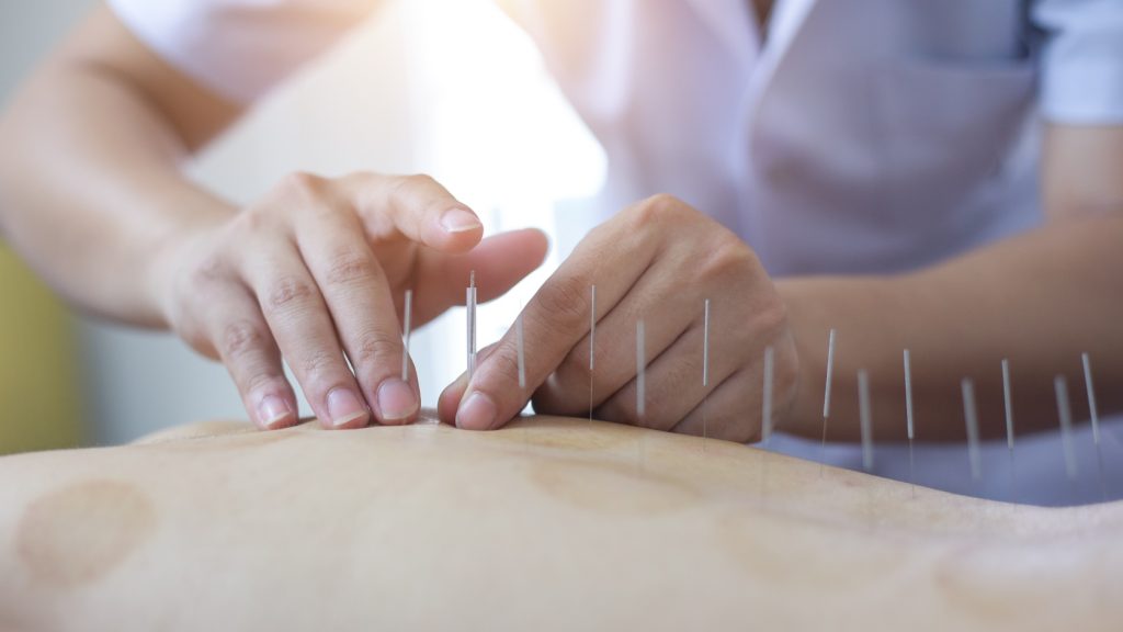 Acupuncture for PCOS or fertility improvement